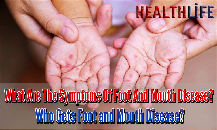 What Are The Symptoms Of Foot And Mouth Disease