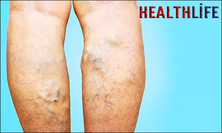 What Are The Symptoms Of Vein Problems In The Legs