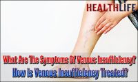 What Are The Symptoms Of Venous Insufficiency