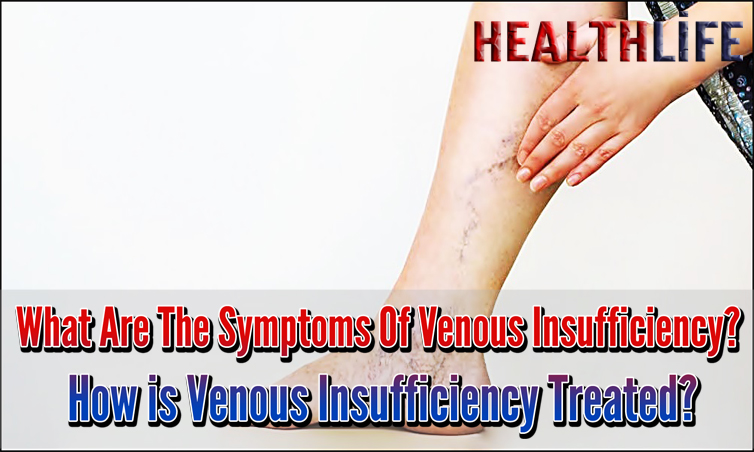 What Are The Symptoms Of Venous Insufficiency