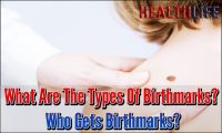 What Are The Types Of Birthmarks