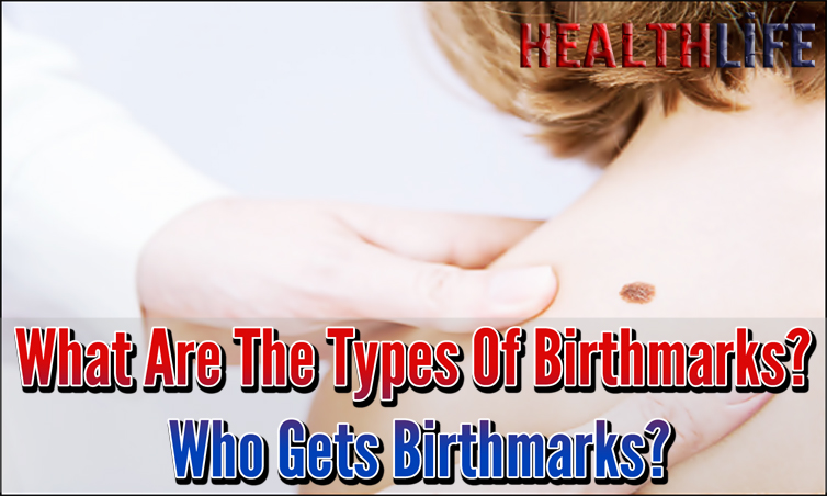 What Are The Types Of Birthmarks