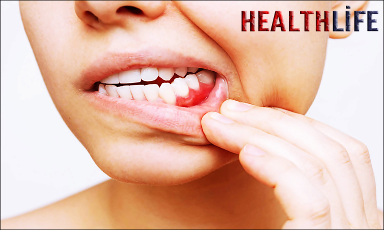 What Causes Bleeding Gums
