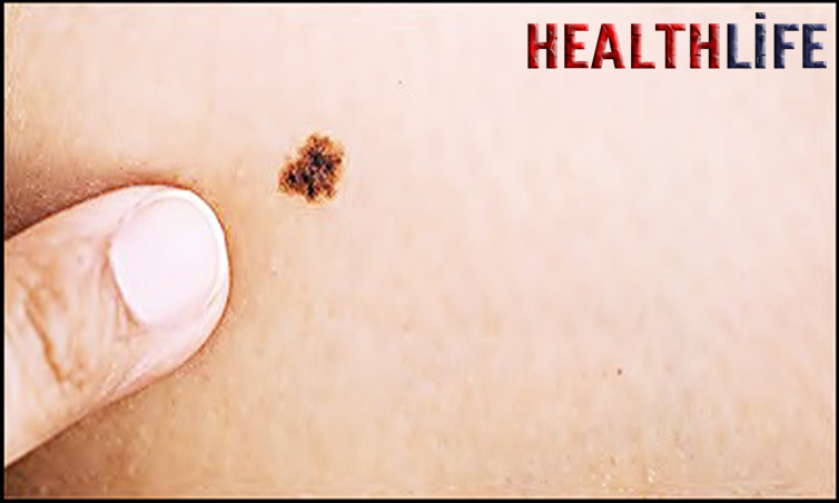 What Is A Rare Type Of Birthmark