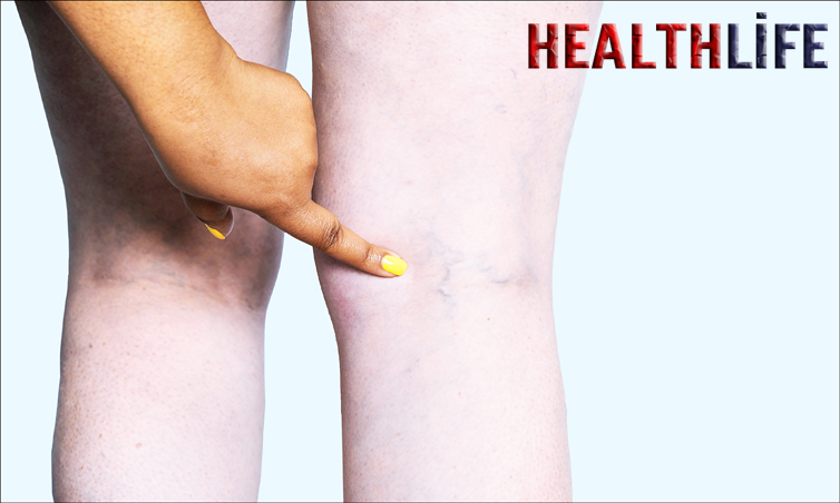 What Is The Best Treatment For Venous Insufficiency