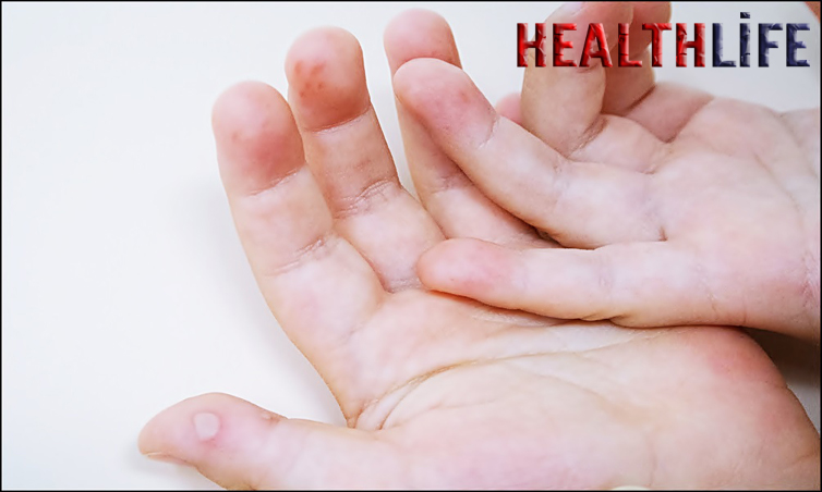 What Is The Cure For Foot And Mouth disease