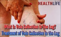 What Is Vein Collection In The Leg