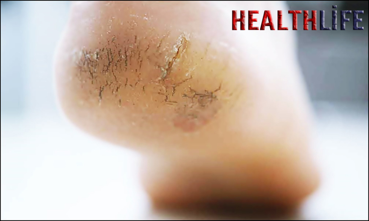 How Do You Treat Hardness On The Bottom Of Your Feet