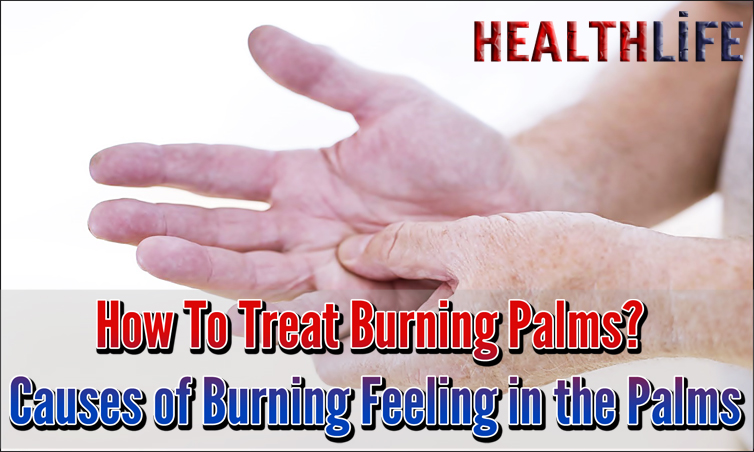How To Treat Burning Palms