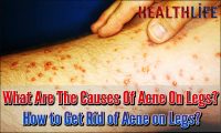 What Are The Causes Of Acne On Legs