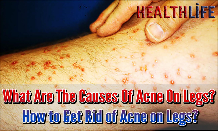 What Are The Causes Of Acne On Legs
