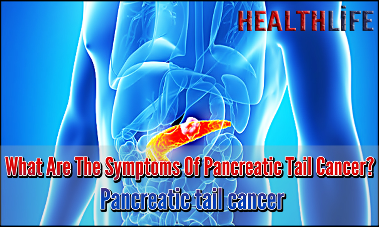 What Are The Symptoms Of Pancreatic Tail Cancer