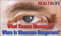 What Causes Glaucoma