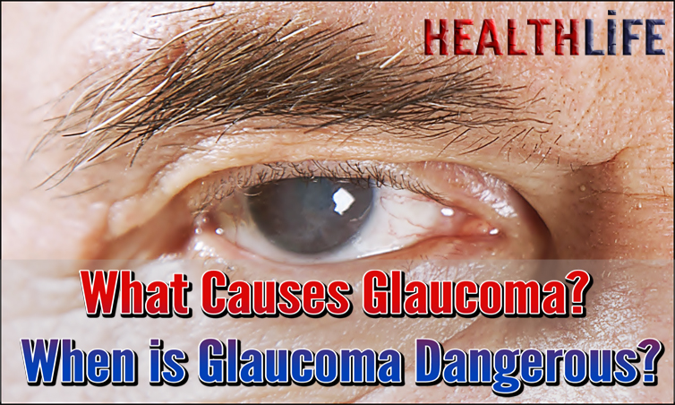What Causes Glaucoma