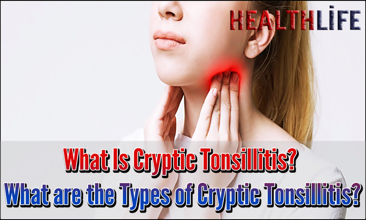 What Is Cryptic Tonsillitis