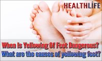 When Is Yellowing Of Feet Dangerous