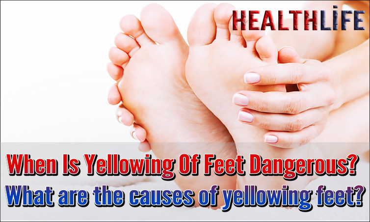 When Is Yellowing Of Feet Dangerous