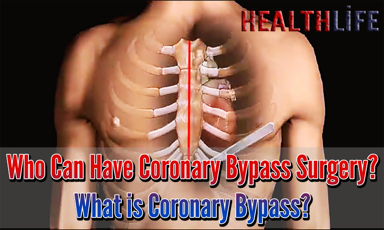 Who Can Have Coronary Bypass Surgery