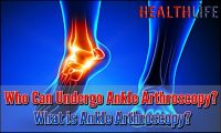 Who Can Undergo Ankle Arthroscopy