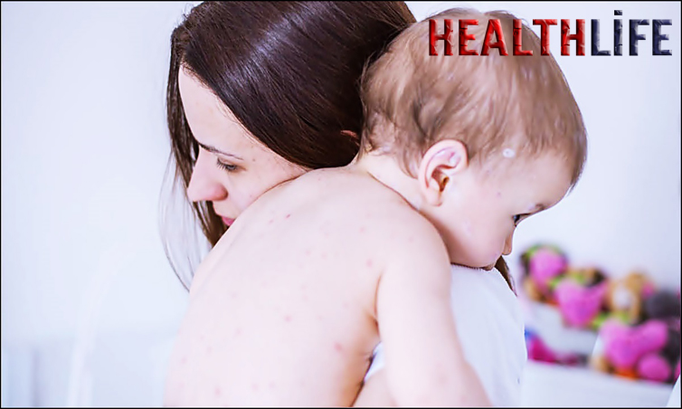 How Do You Confirm If I Have Measles