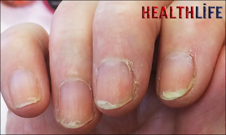 How Do You Know If You Have Nail Cancer