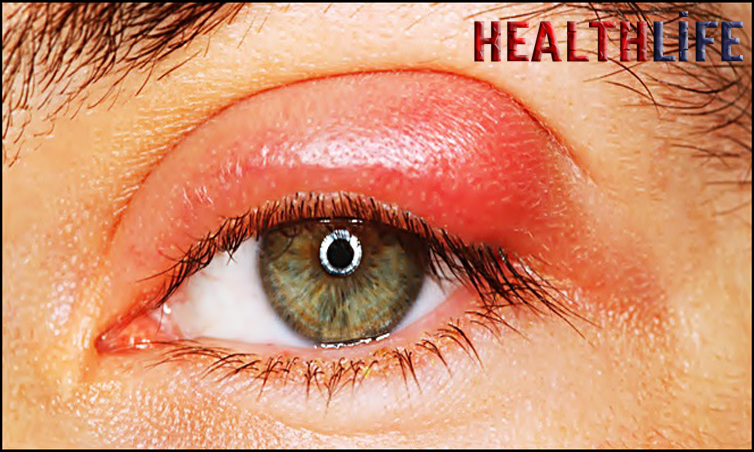 How Do You Reduce Eye Inflammation