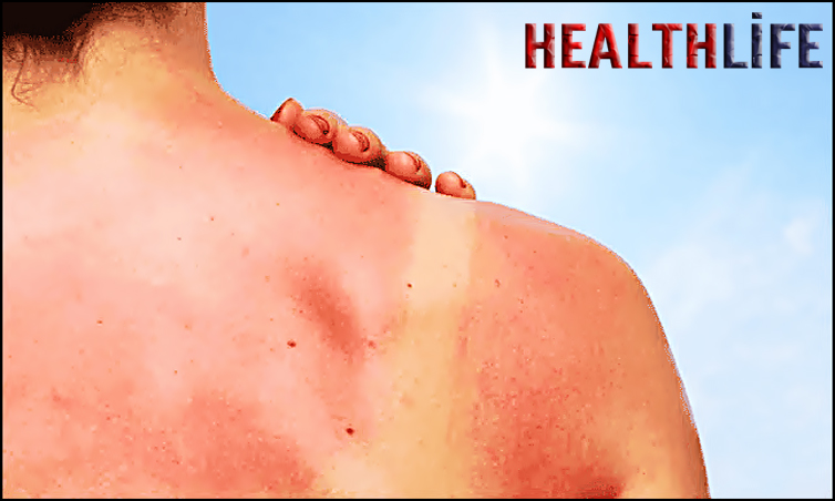 How Do You Sleep With An Itchy Sunburn
