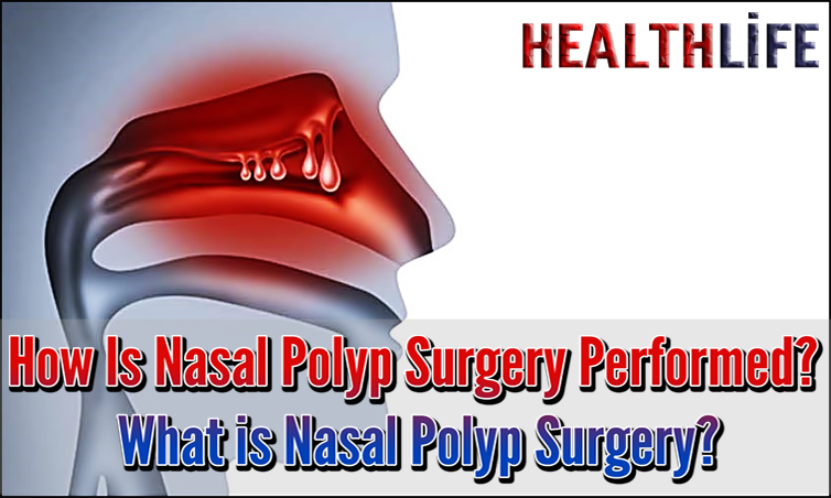 How Is Nasal Polyp Surgery Performed