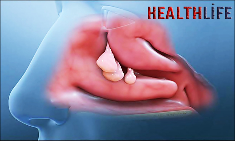 How Long Does Nasal Polyp Removal Surgery Take