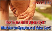 How To Get Rid Of Bakers Cyst