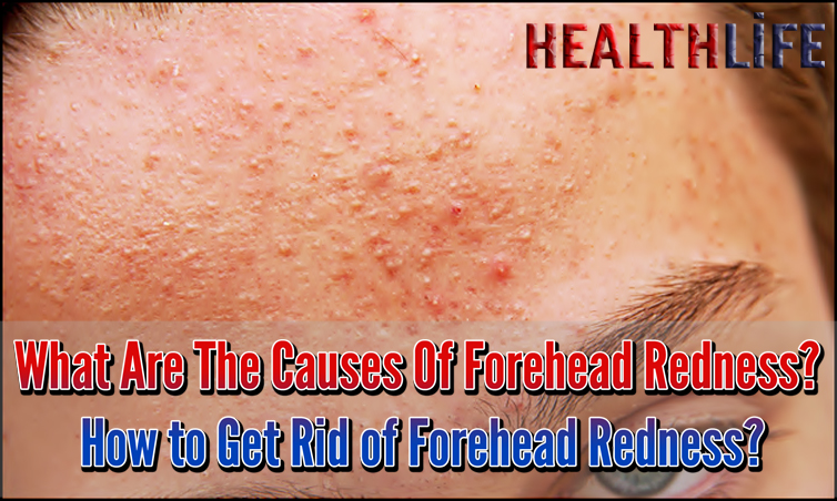 What Are The Causes Of Forehead Redness