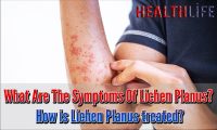 What Are The Symptoms Of Lichen Planus
