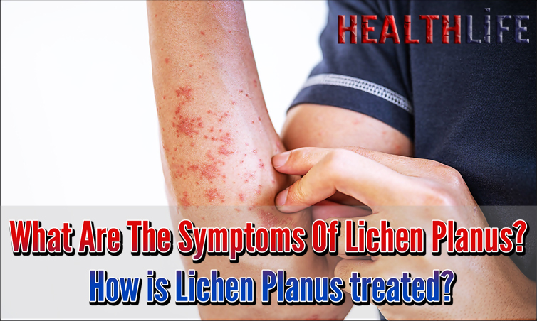 What Are The Symptoms Of Lichen Planus