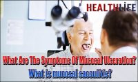 What Are The Symptoms Of Mucosal Ulceration