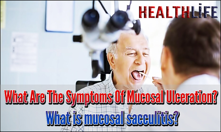 What Are The Symptoms Of Mucosal Ulceration