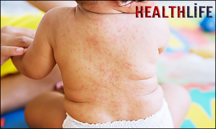 What Can I Put On My Babys Skin For Mosquito Bites