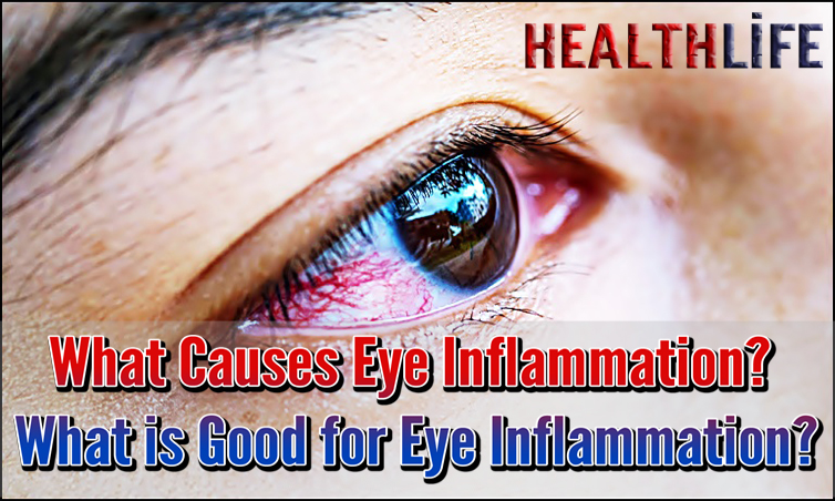 What Causes Eye Inflammation