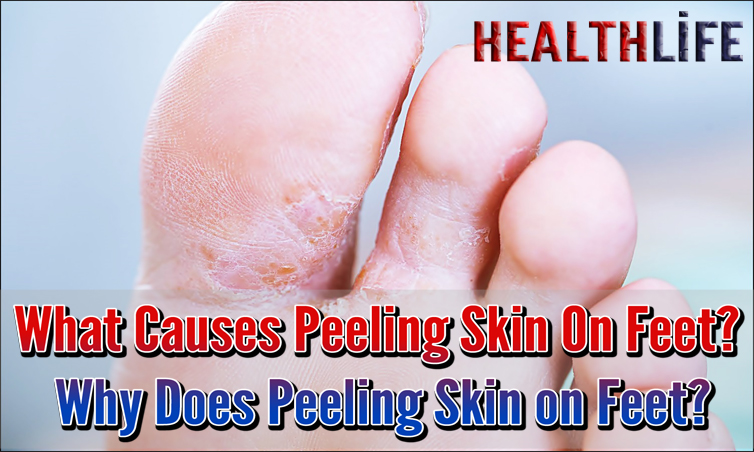 What Causes Peeling Skin On Feet