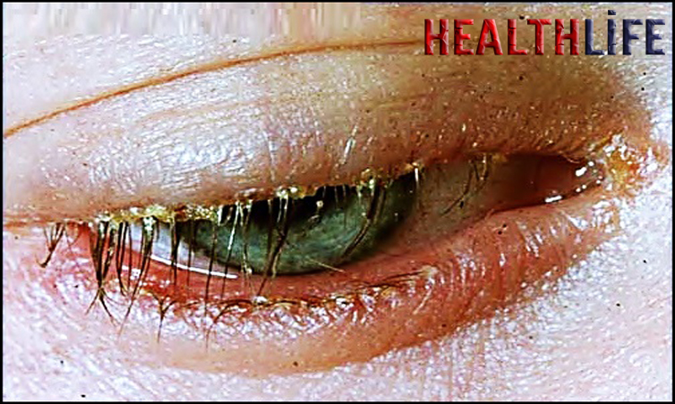 What Causes Scabs On The Eyes