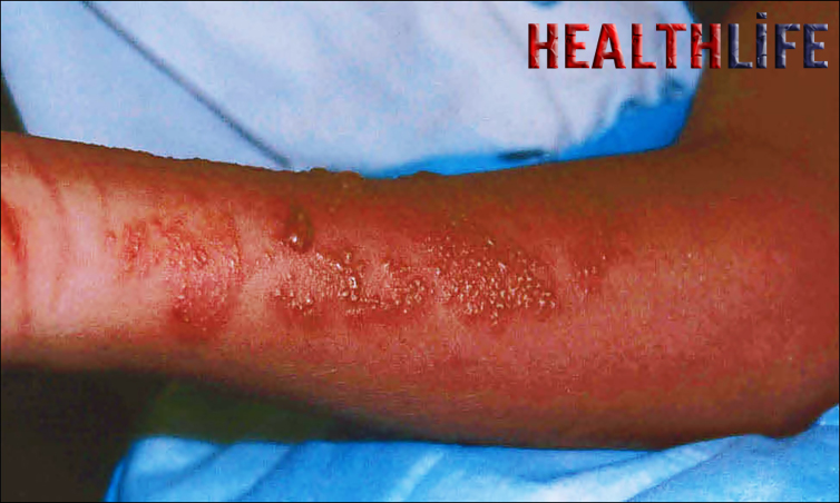 What Is The Best Treatment For a Jellyfish Bite
