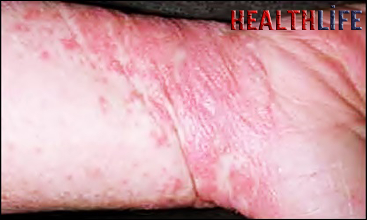 What Is The Fastest Way To Cure Lichen Planus