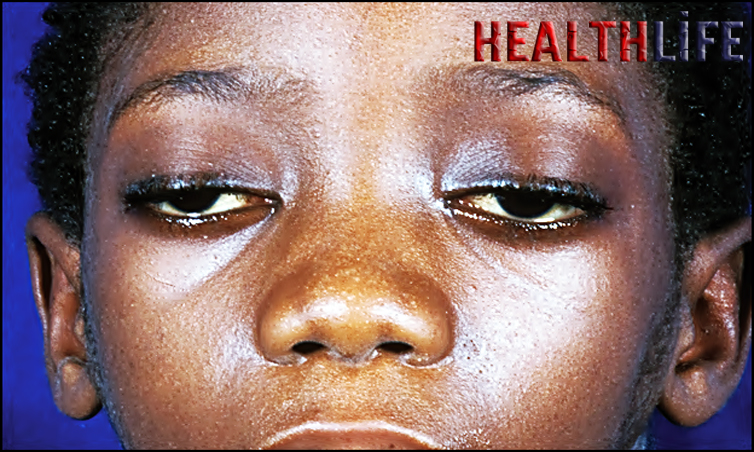 What Is The Main Cause Of Myasthenia Gravis