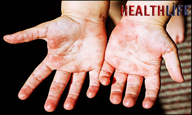 How Do You Know If You'Ve Got Scarlet Fever