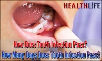 How Does Tooth Infection Pass