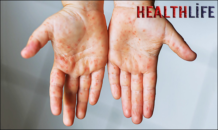 How To Stop HFMD From Spreading