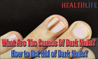What Are The Causes Of Dark Nails