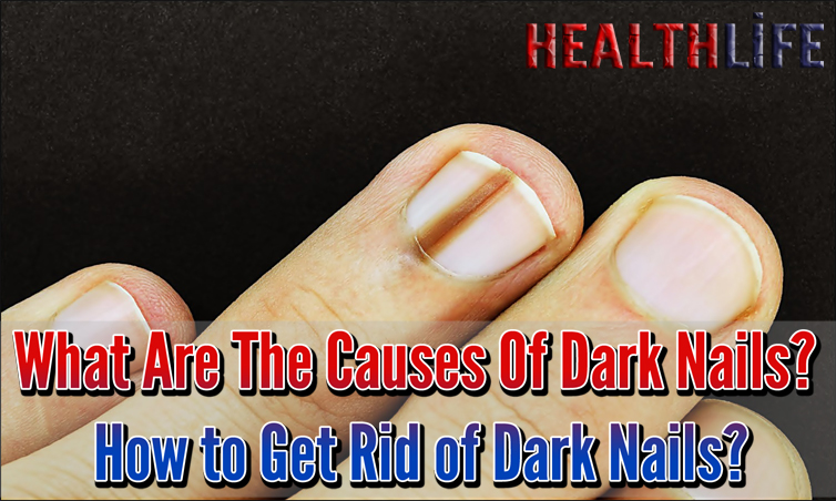 What Are The Causes Of Dark Nails