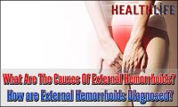 What Are The Causes Of External Hemorrhoids