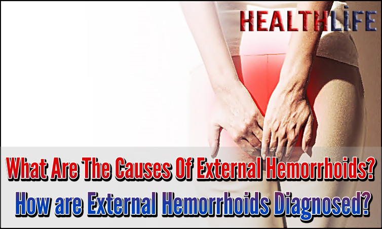 What Are The Causes Of External Hemorrhoids