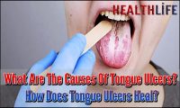 What Are The Causes Of Tongue Ulcers